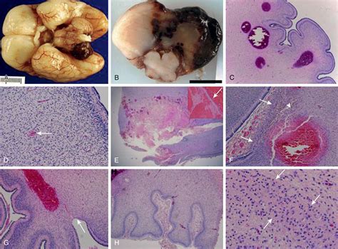 neuropathology near livermore